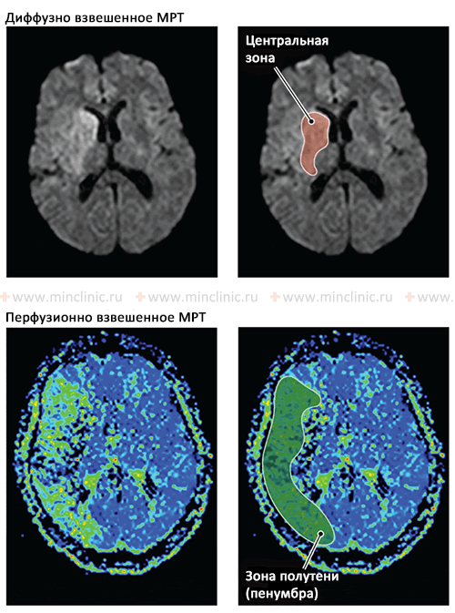 Эмболии сосудов головного мозга (церебральные эмболии) МРТ томография головного мозга в остром (начальном) периоде ишемического инсульта. Видны центральная или ядерная зона инсульта и зона ишемической полутени (пенумбра). Диффузионно-взвешенное МРТ (DWI) показывает гиперинтенсивность, которая соответствует необратимой ишемии в глубине басссейна правой средней мозговой артерии. Эта ишемия поражает хвостатое ядро, внутреннюю капсулу и чечевицеобразное ядро. При перфузионно-взвешенной МРТ (PWI) используется контрастное вещество для оценки мозгового кровотока. Цветовая шкала представляет собой усредненное время прохождения контрастного вещества через ткани мозга; синий цвет обозначает нормальное время транзита, а оттенки зеленого, желтого, оранжевого и красного указывают на задержку контраста (зоны ишемии). В области ишемического ядра контрастное вещество не определяется (черный цвет), что свидетельствует о необратимом повреждении этого участка мозга. Области, окружающие ишемическое ядро, с ненормальным временем прохождения контраста считаются ишемической полутенью (пенумброй).